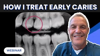 How I Treat Early Caries With Curodont™
