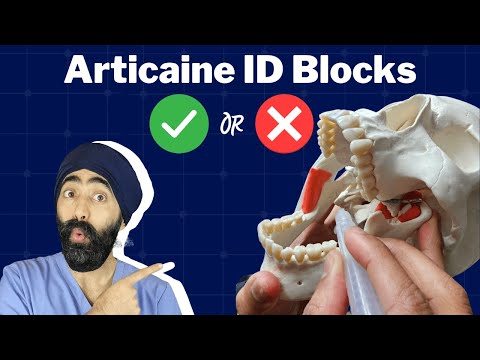 Articaine ID Blocks and the Crestal Intraosseous Approach for Local Anaesthetic - PDP143