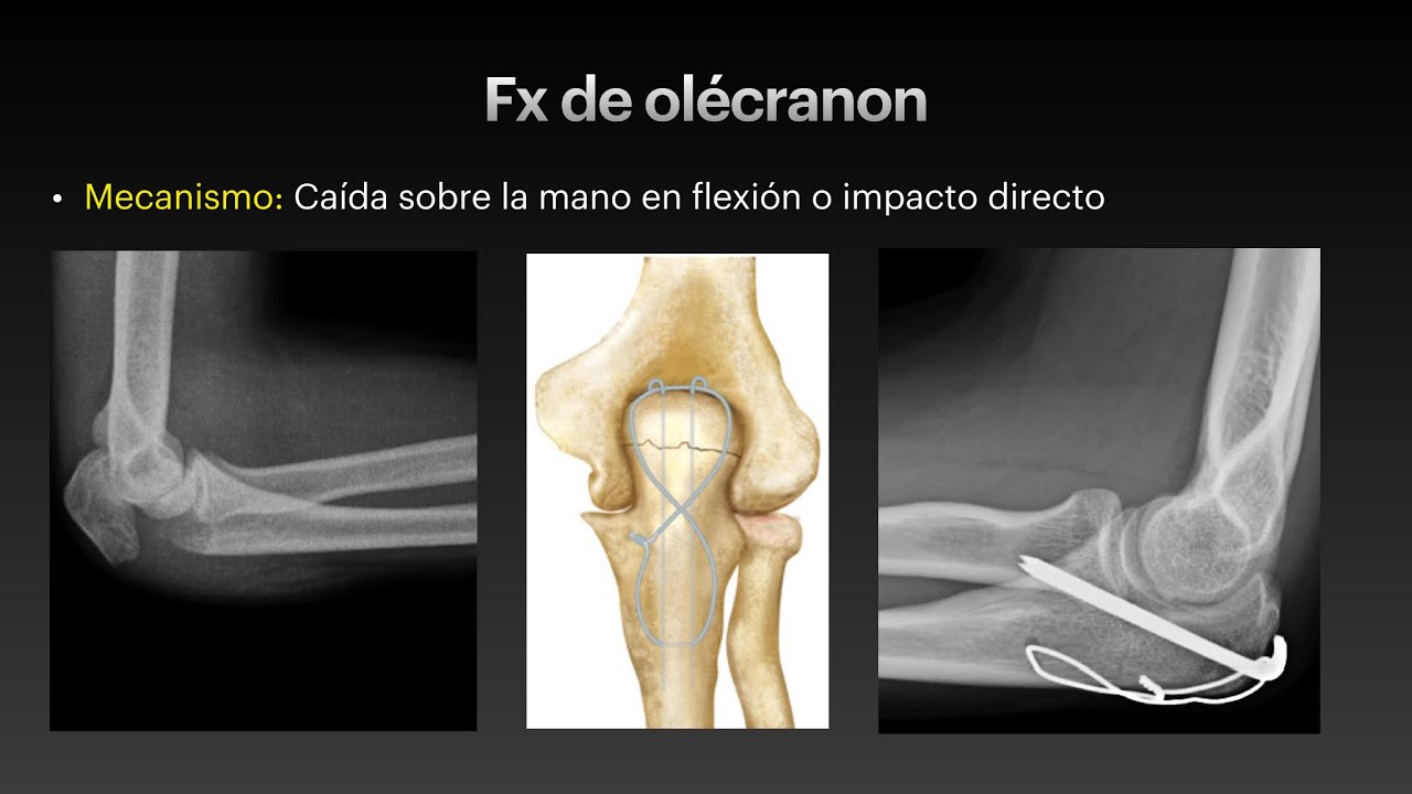 Fracturas de miembro superior