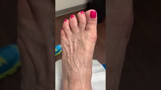 CIRUGÍA MÍNIMAMENTE INVASIVA DEL PIE: QUEILECTOMIA PARA LA ARTRITIS DE LA PRIMERA ARTICULACIÓN ❤️❤️