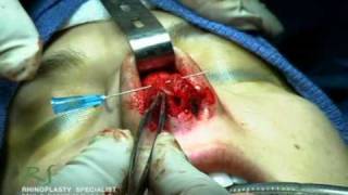 OR Video Footage: Inside a Rhinoplasty Surgery