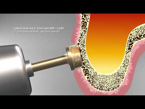 Hydraulic Sinus Lifting Kit