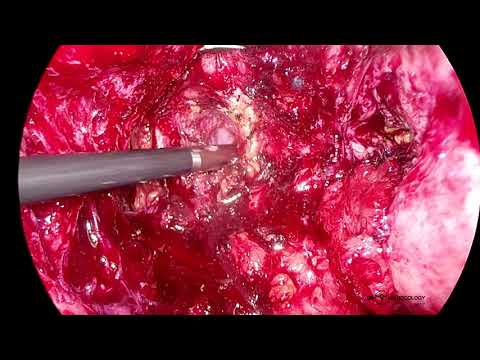 Endometriosis Surgery: Laparoscopic total hysterectomy for Stage IV Endometriosis