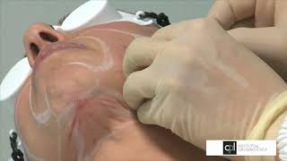 Cómo se hace un lifting facial con Endolight Lift - Cirugía antienvejecimiento con laser