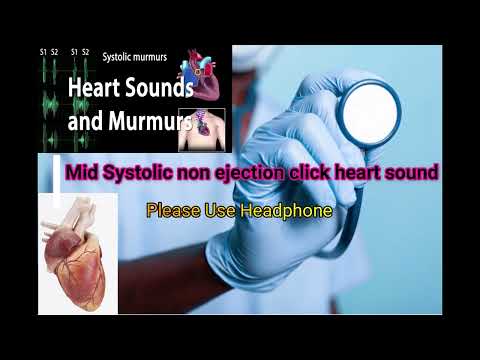 Mid-systolic Non-ejection Clicks Of Heart Sound