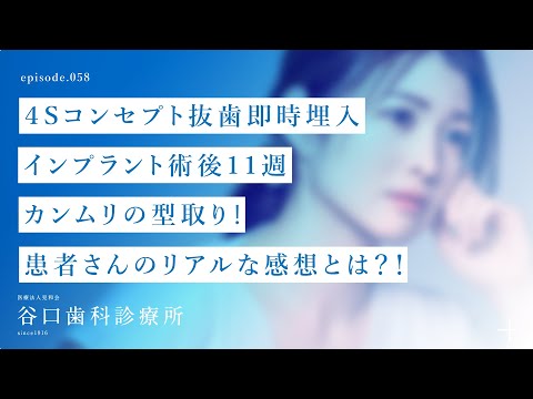 第58話 ４Sコンセプト抜歯即時埋入インプラント術後11週-カンムリの型取り❗️患者さんのリアルな感想とは？！ -札幌駅前-赤れんがテラス-谷口歯科診療所