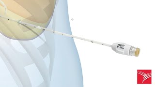 ONE-STEP™ Centesis Drainage Catheters