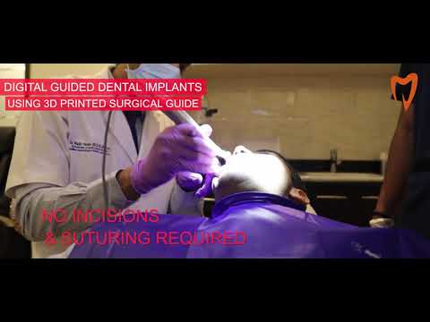 Digital Guided Dental Implant