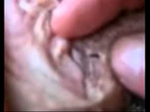 Vorbeugung von akuten Prostatitis bei Männern Chronische Prostatitis Massage Video
