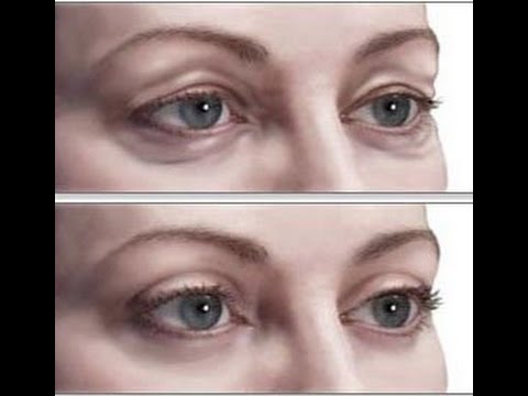 REMÉDIO NATURAL PARA FLACIDEZ DAS PÁLPEBRAS   RESULTADOS EM POUCOS DIAS!