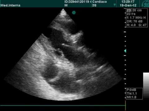 Derrame pleural bilateral en examen de ecografía