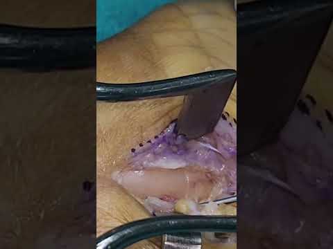 Carpal Tunnel Release Surgery #orthopedicsurgeon #surgeon #mediannerve