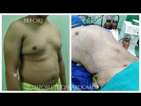 Patient Recovery Case — Video 10 (Liposuction)