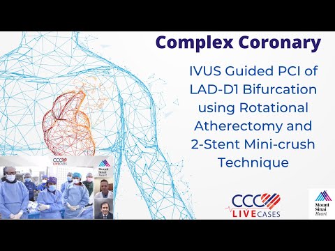 IVUS Guided PCI of LAD-D1 Bifurcation using Rotational Atherectomy and ﻿2-Stent Mini-crush Technique