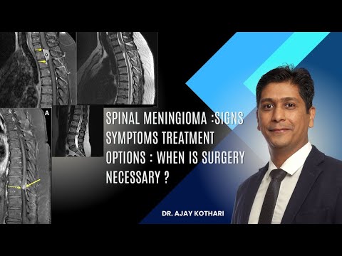 Spinal Meningioma :Signs Symptoms treatment options : when is surgery necessary ? | Dr. Ajay Kothari