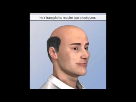 Hair Transplant India, Hair Transplant Centers