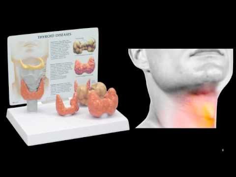 Thyroiditis - YouTube