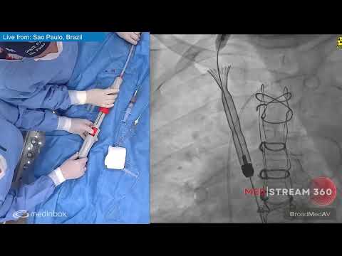 Minimalistic approach with Transcatheter, Bicaval Valves System for Severe Tricuspid Regurgitation