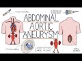 Understanding Abdominal Aortic Aneurysms