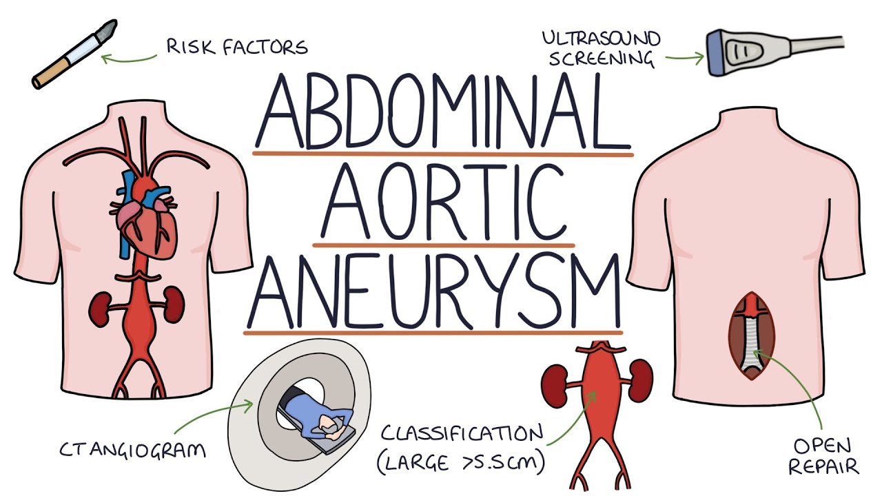 Understanding Abdominal Aortic Aneurysms
