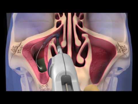 Balloon Sinuplasty Technology - Rev A SPIN Animation - Houston Dr. Michael Eisemann