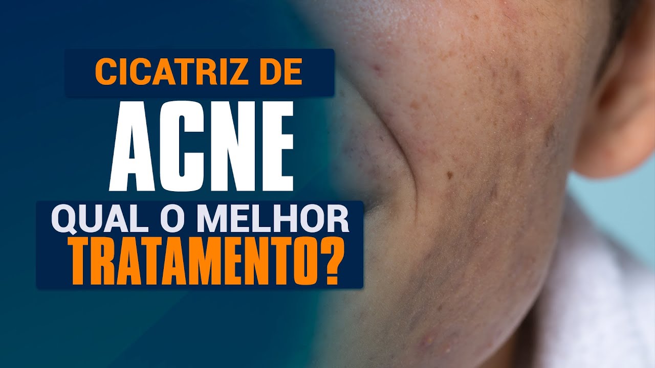 Qual o melhor tratamento para cicatriz de acne?