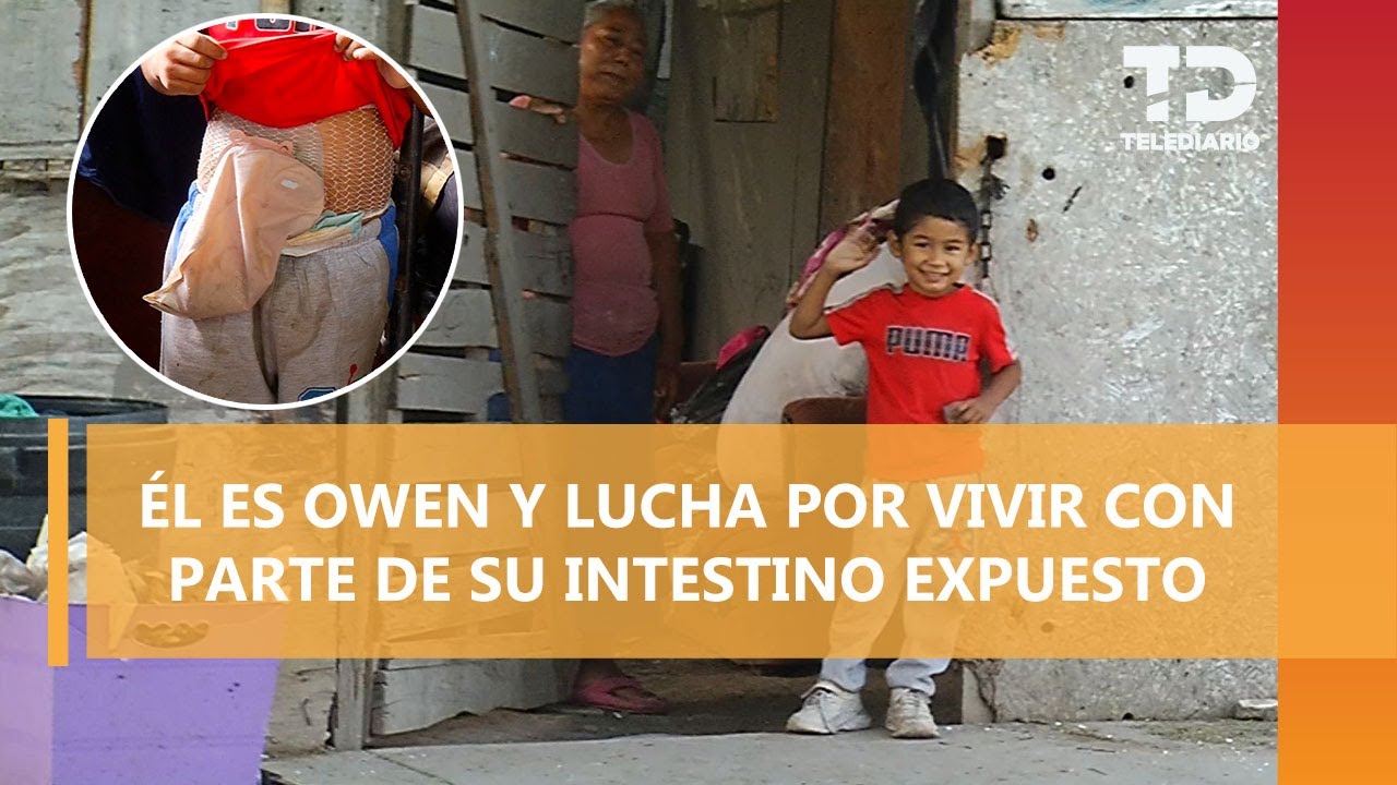 Owen, de 4 años, lucha por vivir con parte de su intestino expuesto; así puedes ayudar