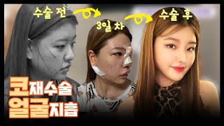 [코성형후기] 윤곽수술 아니고 얼굴지흡 + 코?