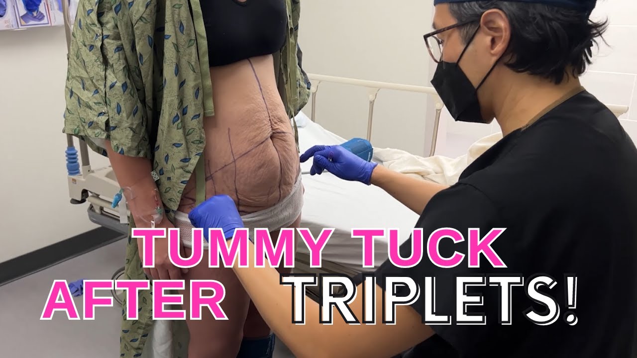 Plastic Surgeon Reveals How I Flattened Her Tummy After Triplets!