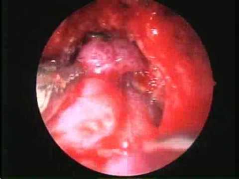 Endoscopic endonasal extended approach for the resection of tuberculum sellae meningioma
