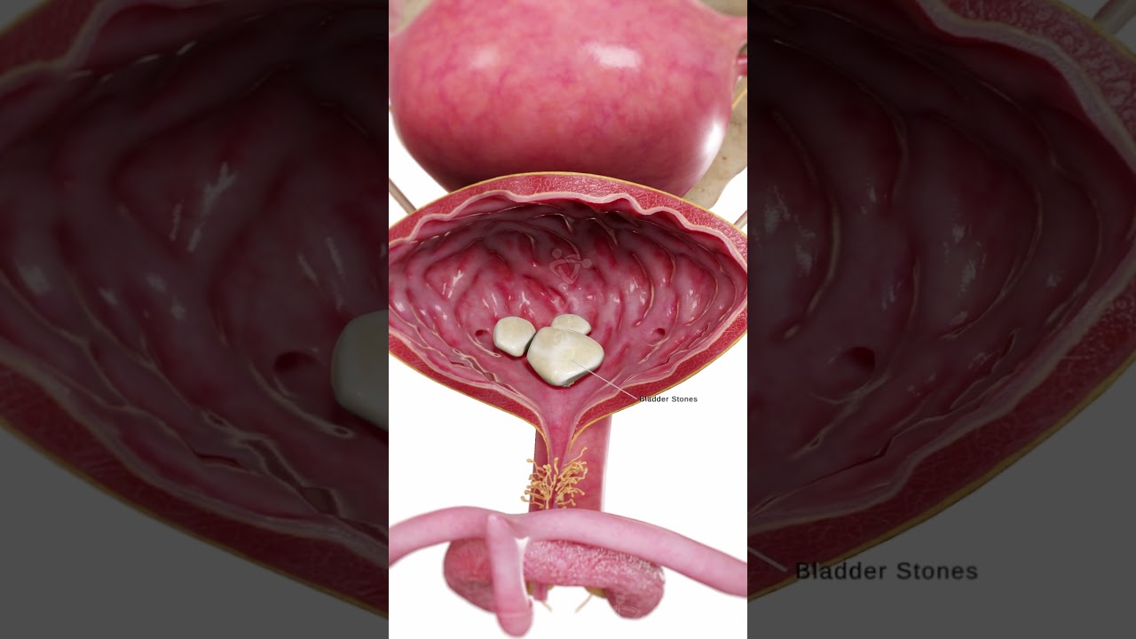 Bladder Stones in 3D | Anatomy Animation