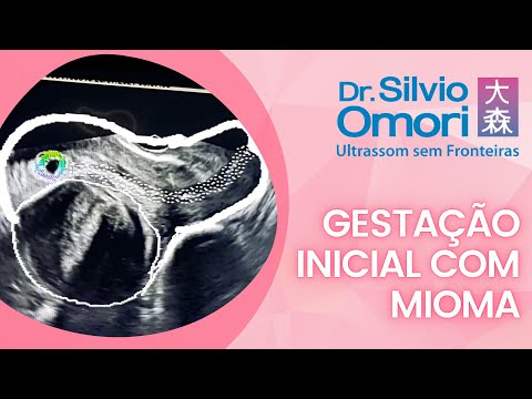 Myoma in early pregnancy.