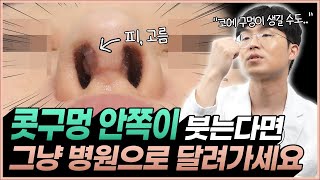 코 수술 후 뚱뚱해진 코안, 흉살인 줄 알고 방치했다가 비중격 연골 다 녹습니다;;