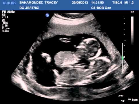 Ultrasound(15 weeks) twins