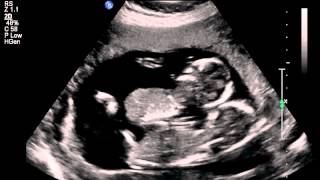 Ultrasound(15 weeks) twins