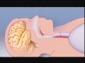 What Is Sleep Apnea