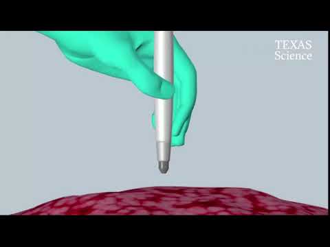 HFE_'Pen' identifies cancer in 10 seconds