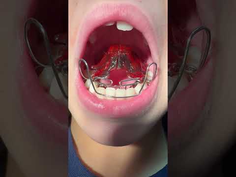 Aparelho ortopédico SN3 com arco de Eschler
