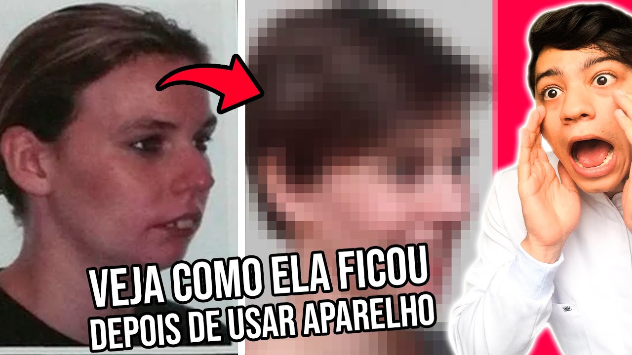 10 Pessoas que FICARAM IRRECONHECÍVEIS depois de tirar o Aparelho !