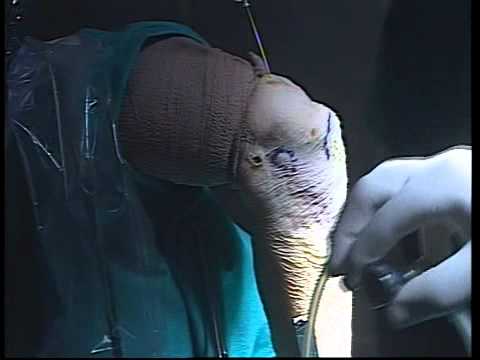 Ernia e protrusione del rachide cervicale Osteocondrosi hondroprotektory recensioni di medici