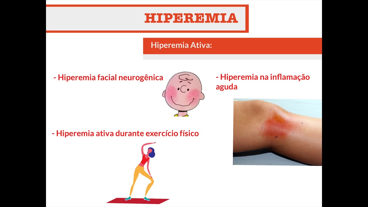Hiperemia (Distúrbios Circulatórios PARTE I) - Patologia