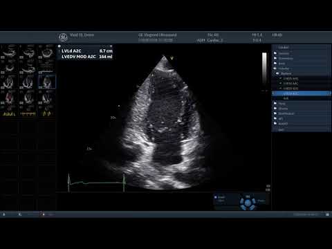 GE Vivid Club   Clinical Library   Simple Cardiac Echo Exam to consider for COVID 19 Patients
