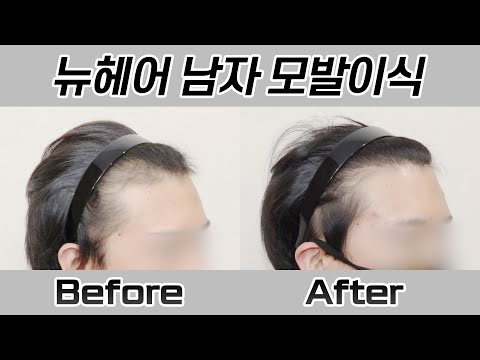 남자 모발이식 1500모낭(3000모) 360일 경과 I 뉴헤어 I Before&After [헤어라인][모발이식]