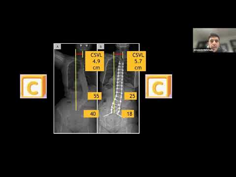 Coronal Alignment in Adult Spinal Deformity : Alekos Theologis, MD - March 10, 2023