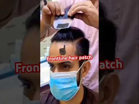 Frontline problem solve. Best Frontline patch available. Natural looking hair patch. Hairstyle