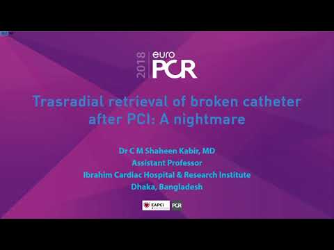 Broken coronary catheter retrieval, trans radial.