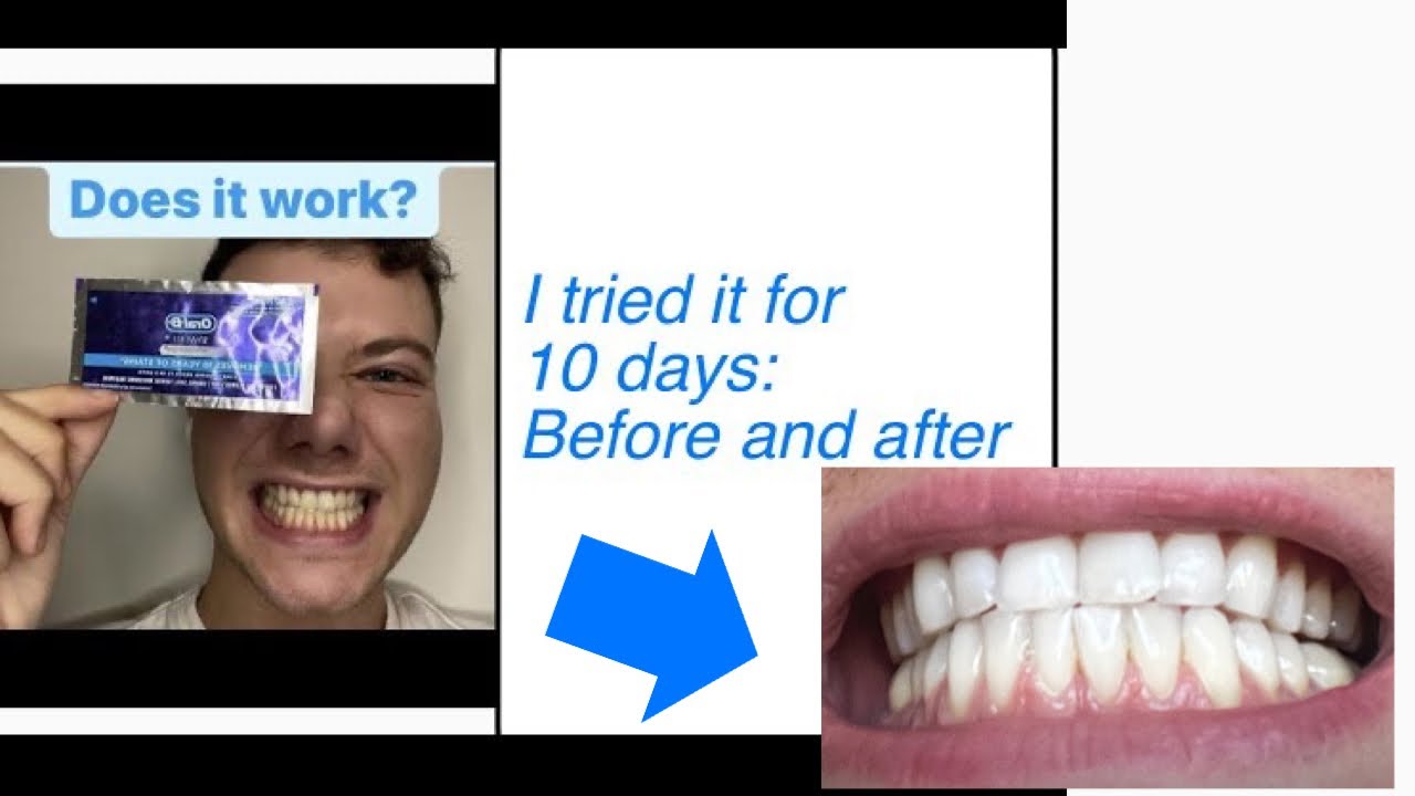 10 Days Later: Honest Review of Oral-B Whitening Strips - Before and After Results