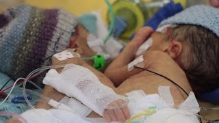 8-Day-Old Conjoined Twins Are Youngest Ever To Survive Separation Surgery
