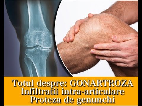 Tratamentul artrozei articulațiilor genunchiului și șoldului