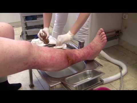 Telangiectasia vagy vörös foltok kezelése a lábakon